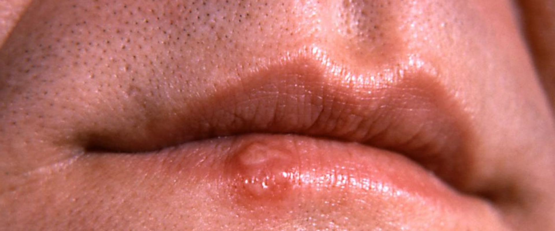 What are the Symptoms and Treatments of Sexually Transmitted Diseases?