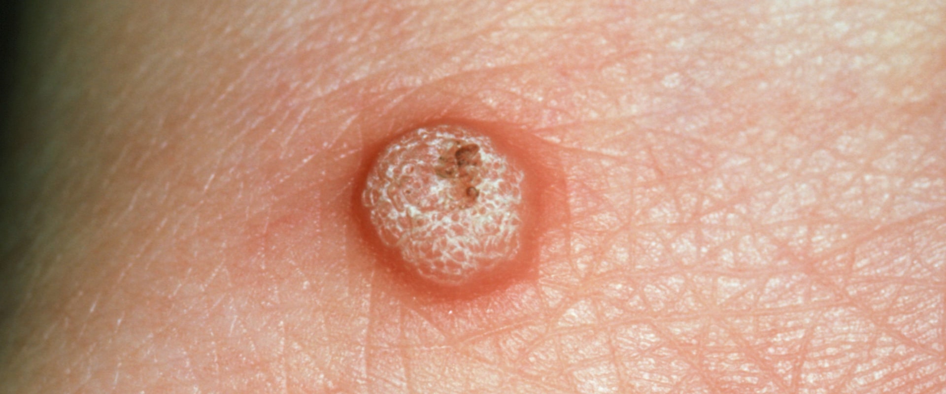 Signs of an STD in Women: What to Look Out For
