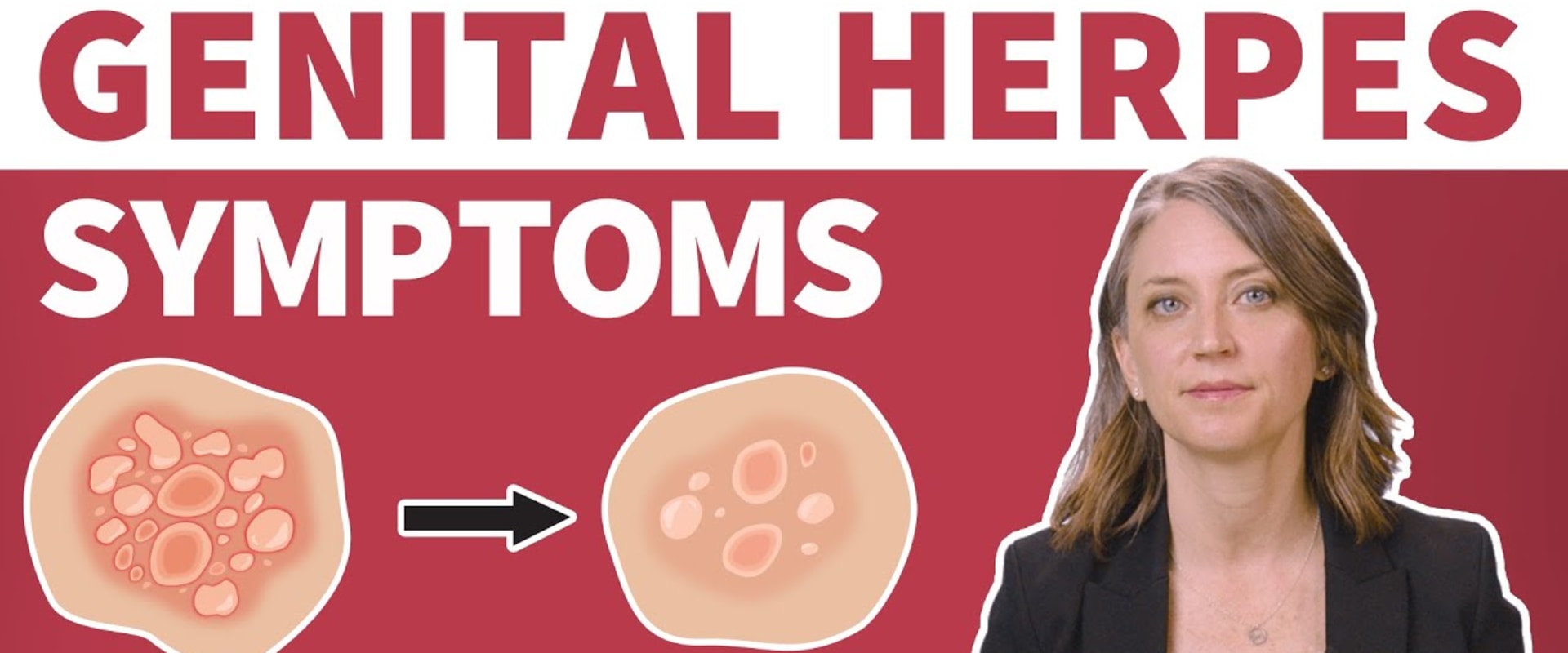 Understanding Herpes Symptoms: What You Need to Know