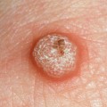 Signs of an STD in Women: What to Look Out For