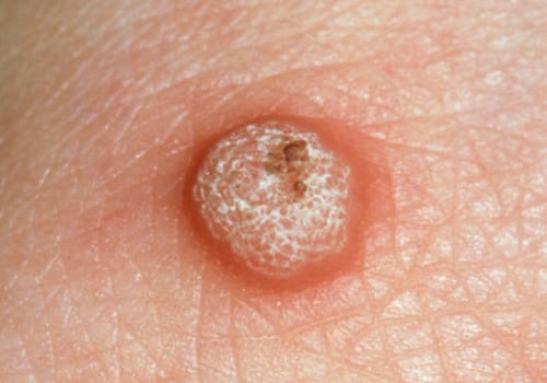 Signs of an STD in Women: What to Look Out For