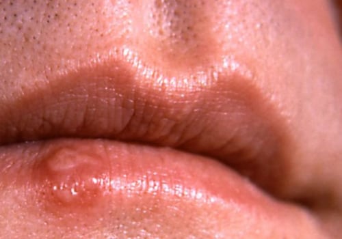 What Does an STD Feel Like for a Woman?